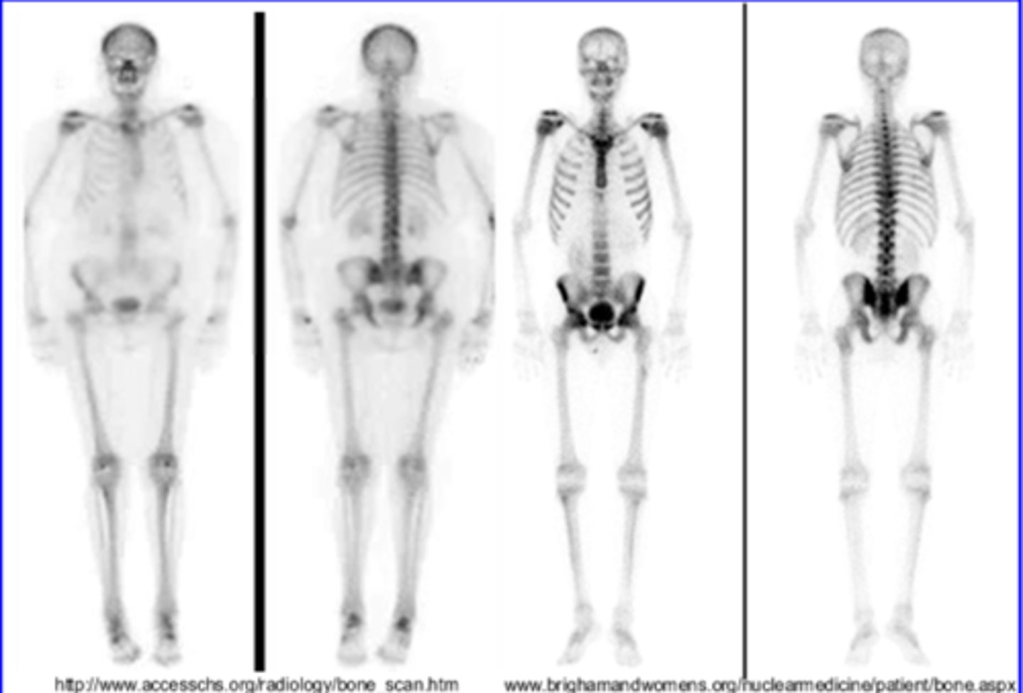 <p>the patient is larger which is causing more scatter</p>
