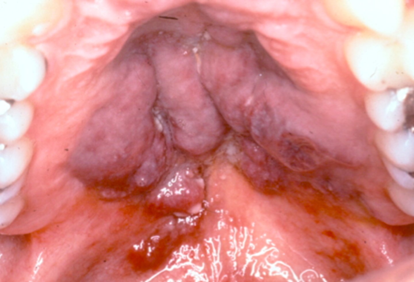 <p>multiple reddish-purple, irregular nodules or papules</p><p>• skin lesions</p><p>• associated with HIV</p><p>• common locations: palate, gingiva</p>