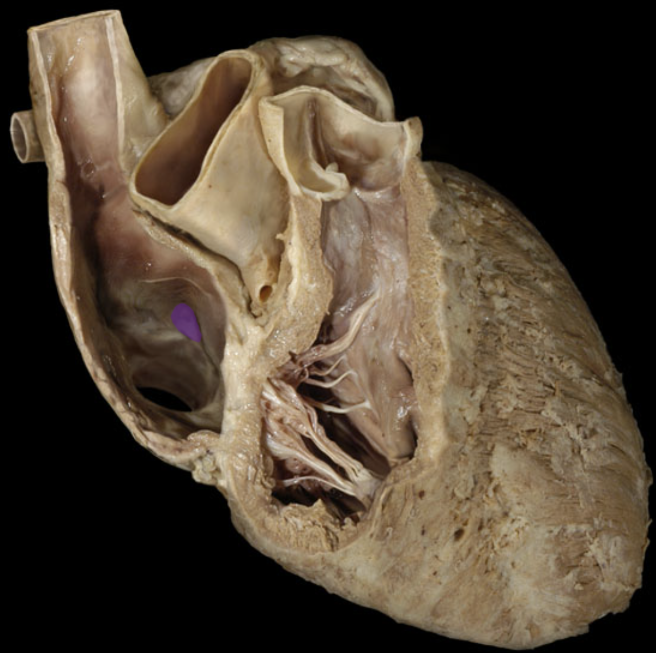 <p>Fossa ovalis</p>