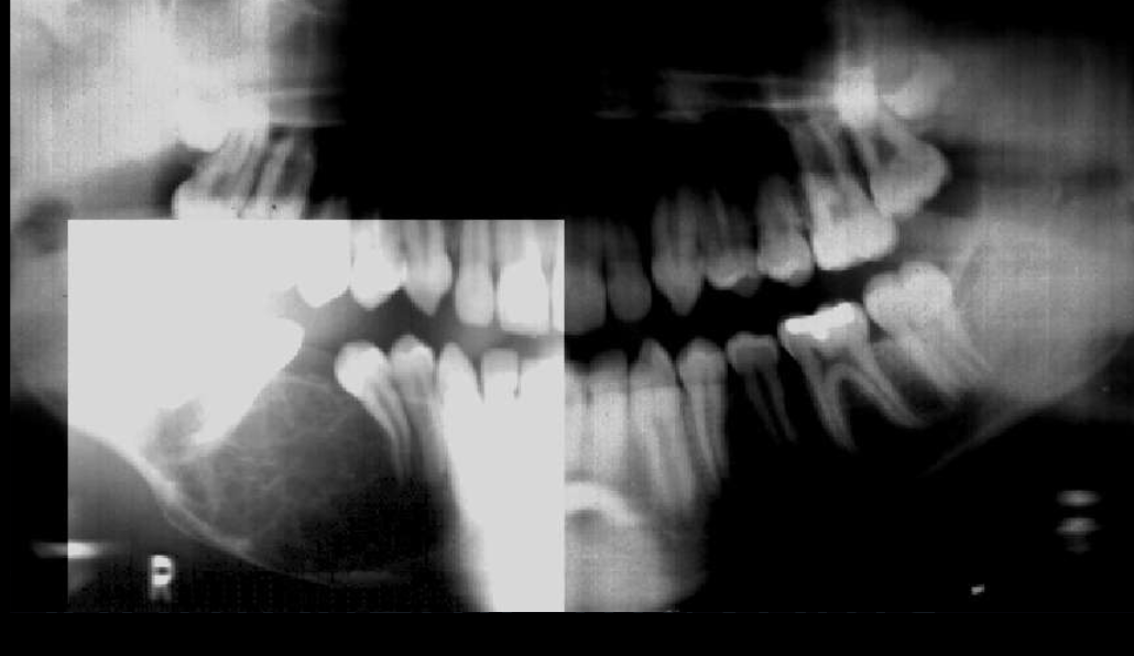<ol><li><p>variable margins: well or poor defined </p></li><li><p>radiolucent </p></li><li><p>straight + thin septae </p></li></ol><p></p>