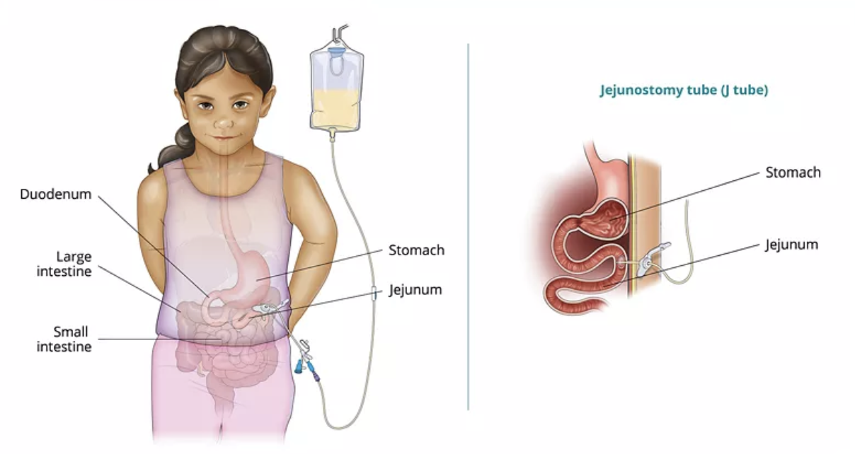 <p><strong>long term feeding tube that enters through jejunum and bypasses the stomach to access small intestine</strong><br>-used to feed, low aspiration risk</p>