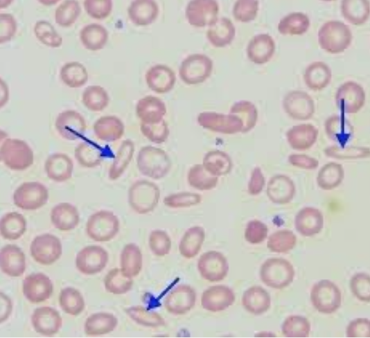 <p>What type of smear cell and what conditions is it seen in</p>