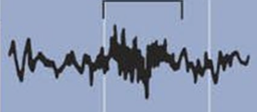 the EEG waveform indicated by the bracket in the figure below is called a ______ and is a characteristic of ______ sleep

a. sleep spindle, stage 2

b. sleep spindle, stage 3

c. slow wave, stage 2

d. slow wave, stage 3

e. slow wave, stage 4