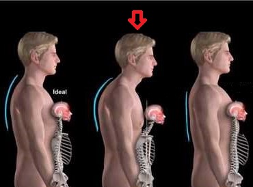 An exaggerated outward/posterior curvature of the thoracic spine resulting in a rounded, “humpback”.