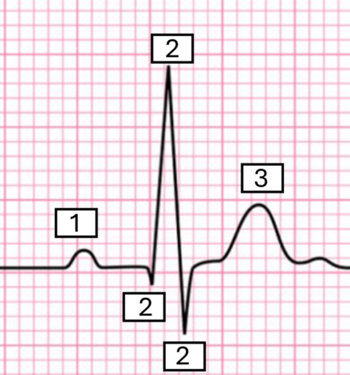 <p>what is the electrical activity of wave #1?</p>