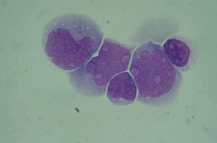 Figure 17: Monoblasts and two lymphocytes