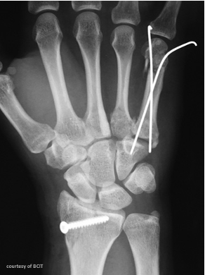 <p>K-wires</p>