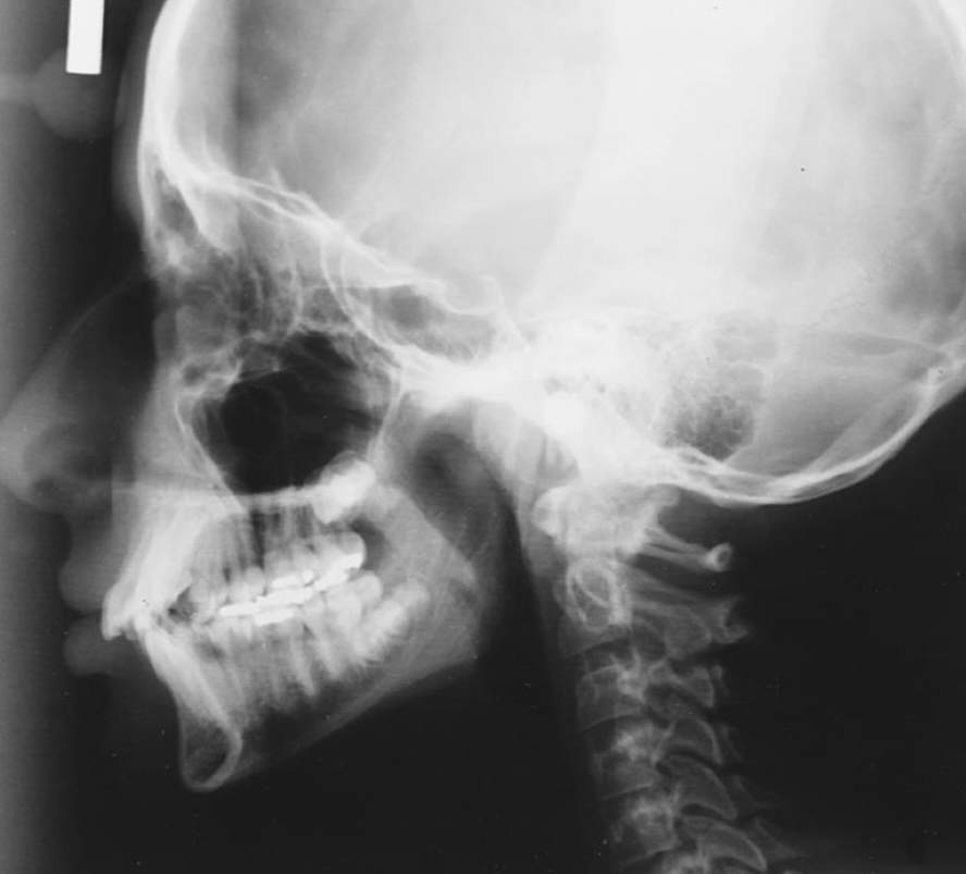 <p>Cephalimetric Radiograph</p>
