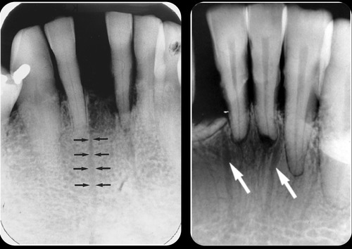 <p>anatomic structures of the alveolar bone through which neurovascular elements transit</p>