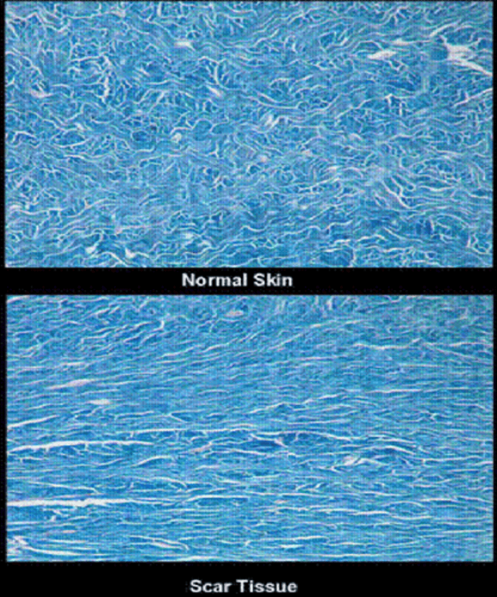 <p>replacement of original skin tissue (reticular/basket weave collagen) with collagenous tissue = more densely packed parallel collagen = altered appearance, less elasticity</p>