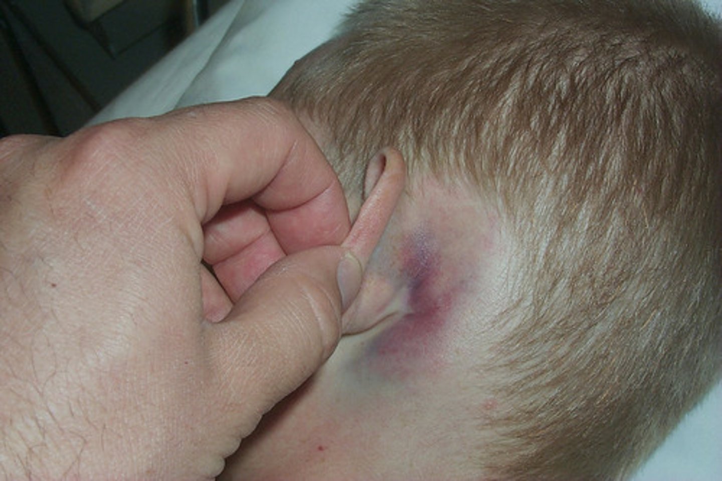 <p>battles sign</p><p>can also have CSF otorrhea</p><p>if a patient has this, what other injury must be present? tympanic membrane rupture! how else would the CSF leak out?</p>