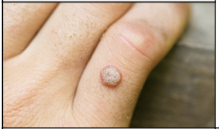 <p>Rough, irregular skin lesion caused by the human papillomavirus (HPV); occurs on hands, fingers, or soles of the feet. also known as a wart</p>