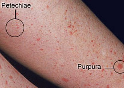 <p>Purpura are flat &lt;1cm spots with less than 4mm in diameter</p><ul><li><p>Can be purple/red spots and patches on <strong>skin and mucous membrane, including the lining of the mouth</strong></p></li></ul><p>Petechiae are flat lesions, greater than 1 cm and have a diameter that is from 4-10 mm</p>