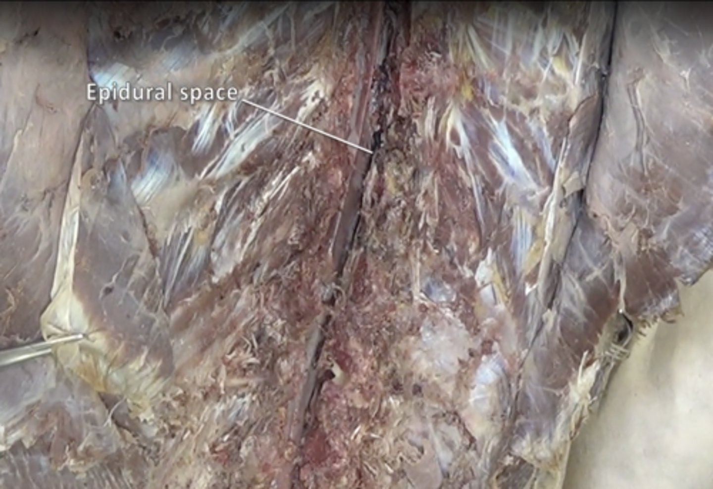 <p>space between the dura mater and the arachnoid mater</p>