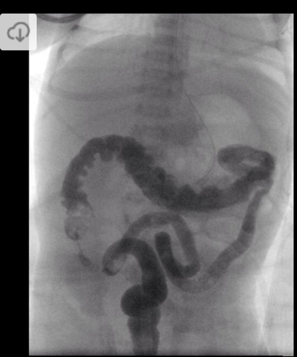 <p>Contrast enema - incomplete microcolon (d/dx from meconium ileus where the entire colon will be micro)</p>