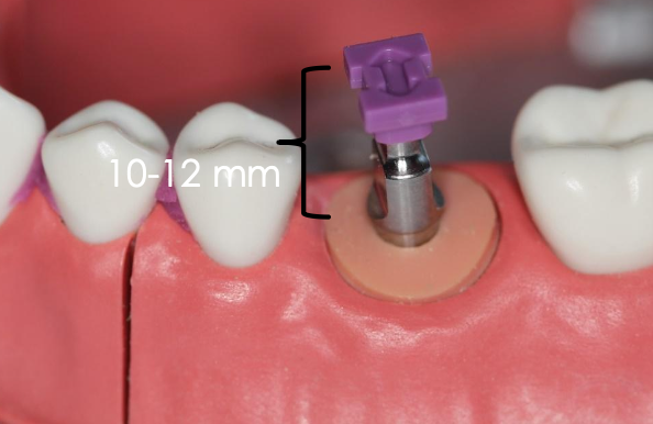 <p>What should the vertical clearance be for the closed tray impression technique?</p>