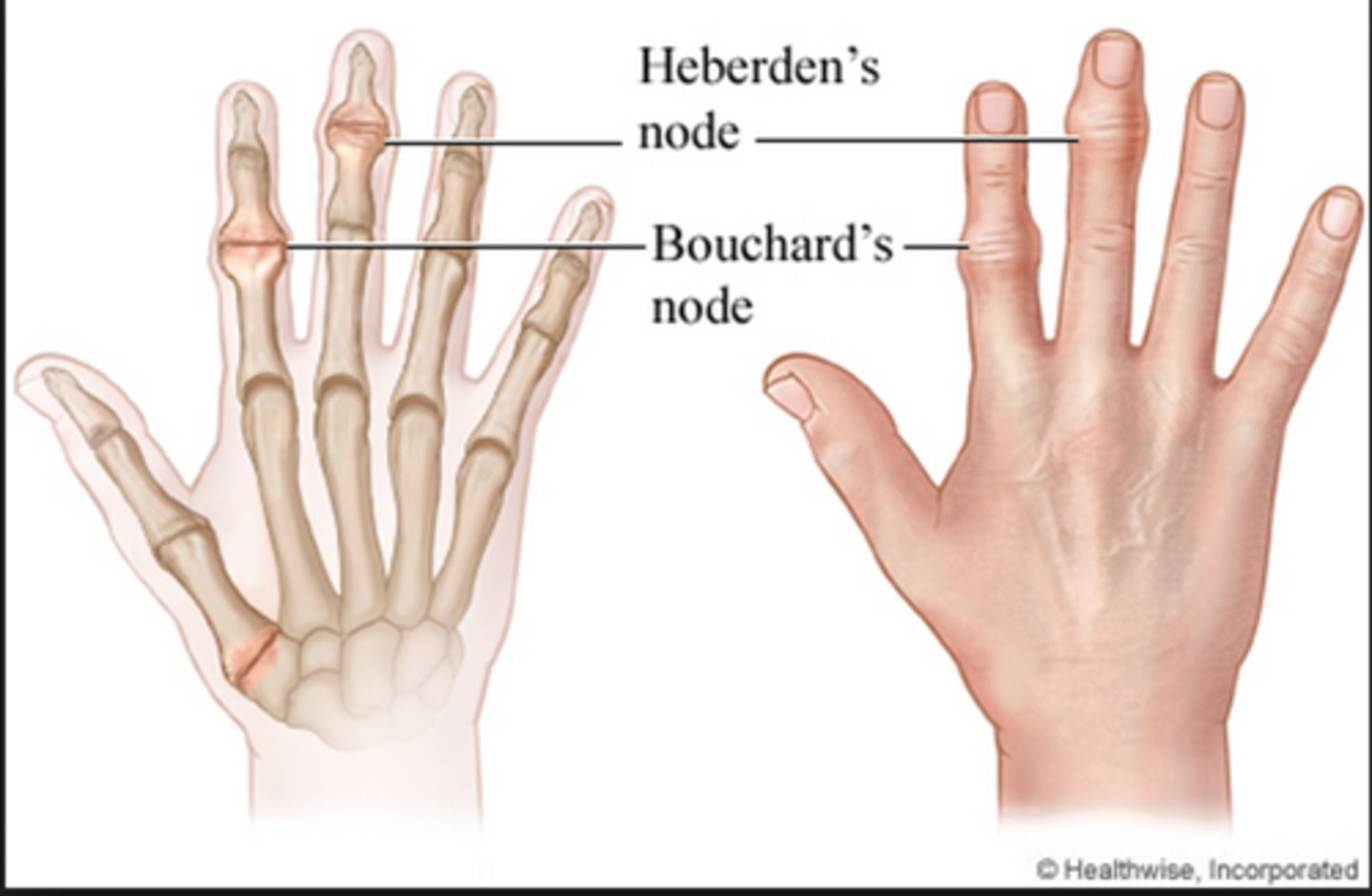 <p>hard non-tender non-inflammatory nodules</p><p>-on DIP as Heberden nodes</p><p>- on PIP are Bouchard nodes</p><p>-occurs with OA</p>