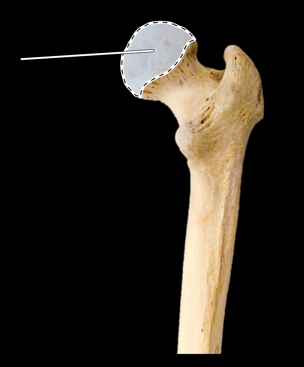 <p>Name the highlighted portion.</p><p>(Femur, posterior view, right side).</p>
