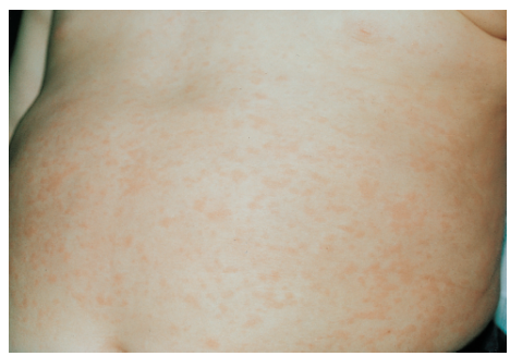 <p>roseola</p>
