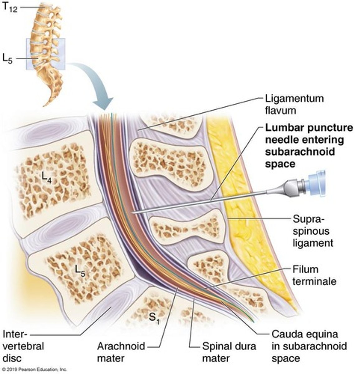 <p>A lumbar puncture penetrates the dura to access CSF for pathological testing or drug administration.</p>
