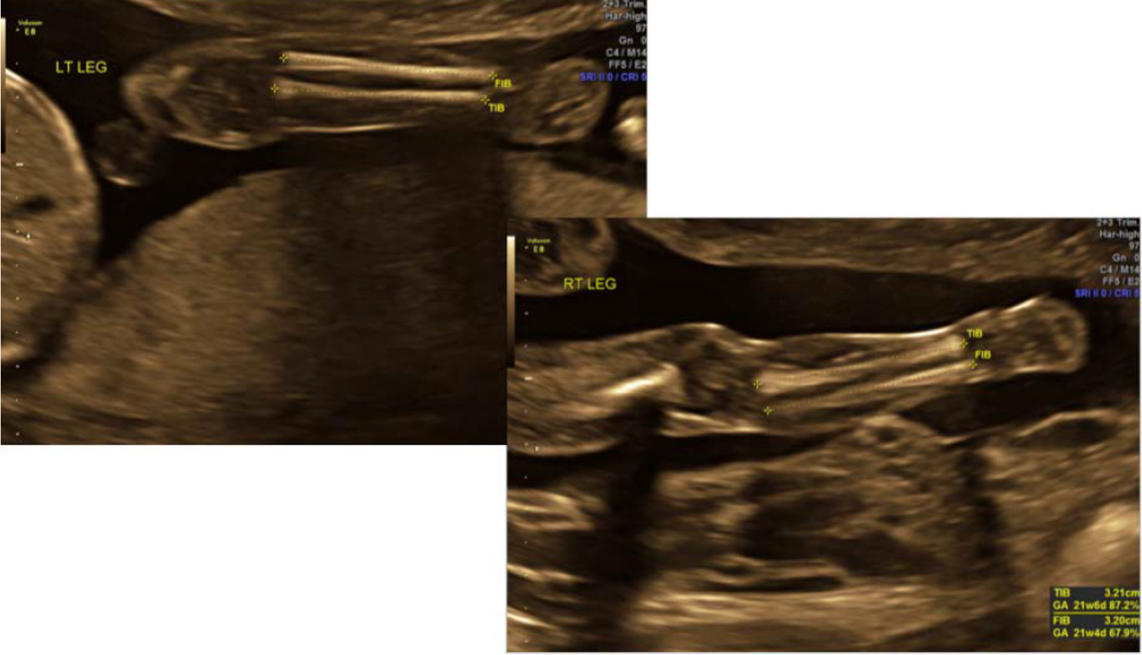 <ul><li><p>tibia thicker and in medial position</p></li><li><p>fibula is laterally located and extends more inferiorly (into ankle)</p></li></ul>
