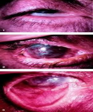 <p>a reactive hyperplasia like <strong>increased mucous membrane epithelium</strong> is caused by</p>