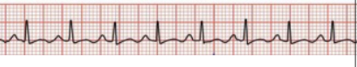 NRS but faster 

CS- fear, anemia, pain, heart failure 

TX- none if from pain, NSAID, analgesia, blood transfusion 