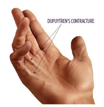 <p>-Contraction of palmar fascia, fixed flexion of MCP and PIP joints of 4th &amp;/or 5th digits</p><p>-Males > females</p>