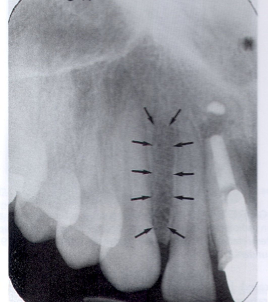 <p>What is the radiolucent structure seen here?</p>