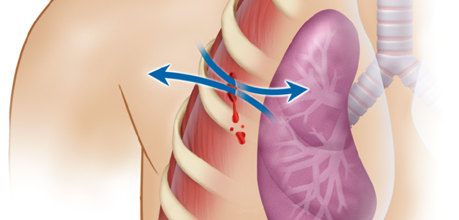 open or penetrating chest wall wound through which air passes during inspiration and expiration, creating a sucking sound 