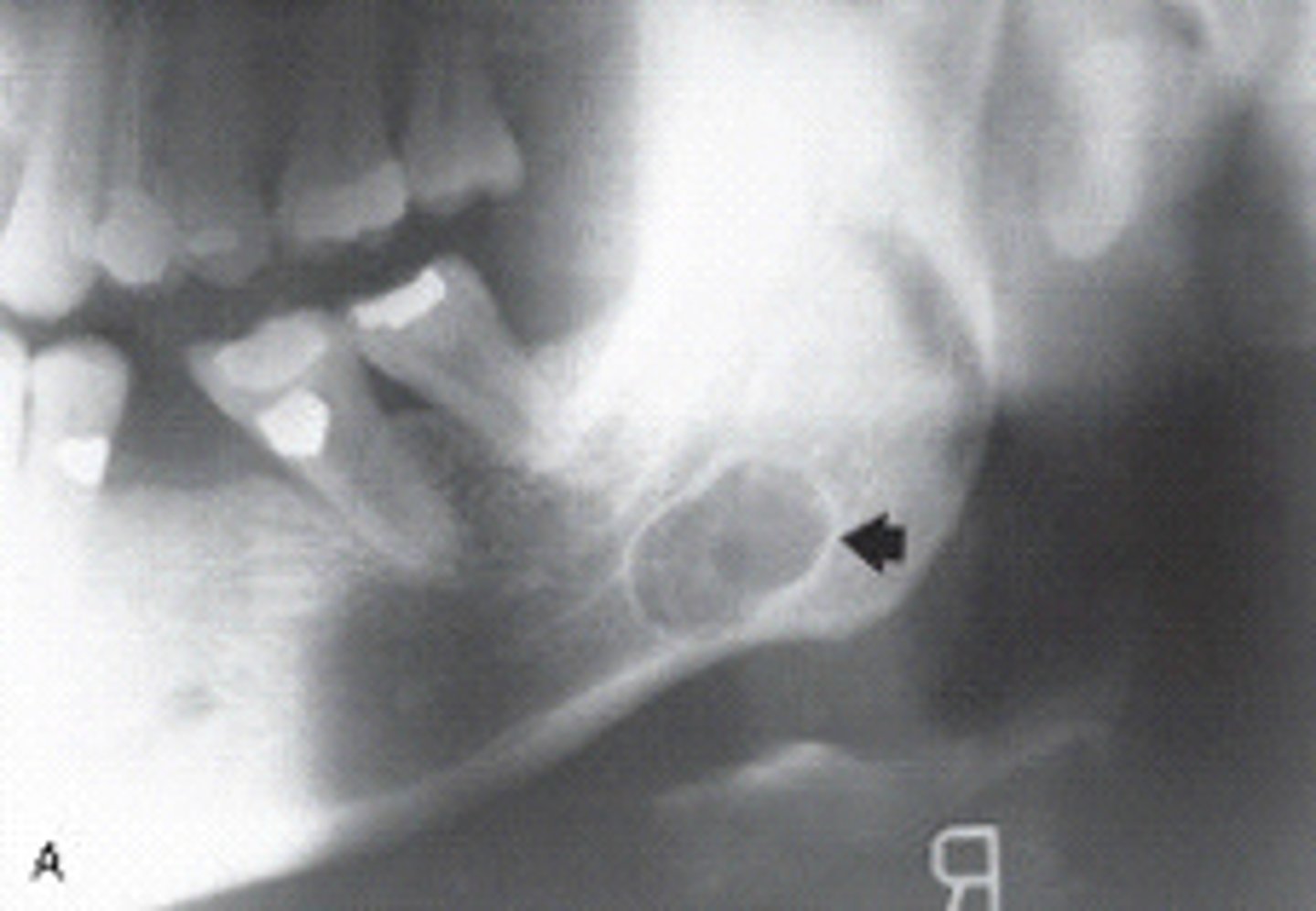 <p>Stafne bone defect</p><p>Stafne bone cyst</p><p>a pseudocyst filled with salivary gland tissue and may be an extension of the sublingual gland. ct.</p>