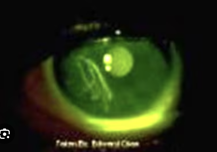 <p>17 y/o female presents to the ED for eye pain possibly due to a foreign body. She said it happened RIGHT after she took her makeup off. On physical you note linear uptake with fluorescein. What’s your gameplan?</p>