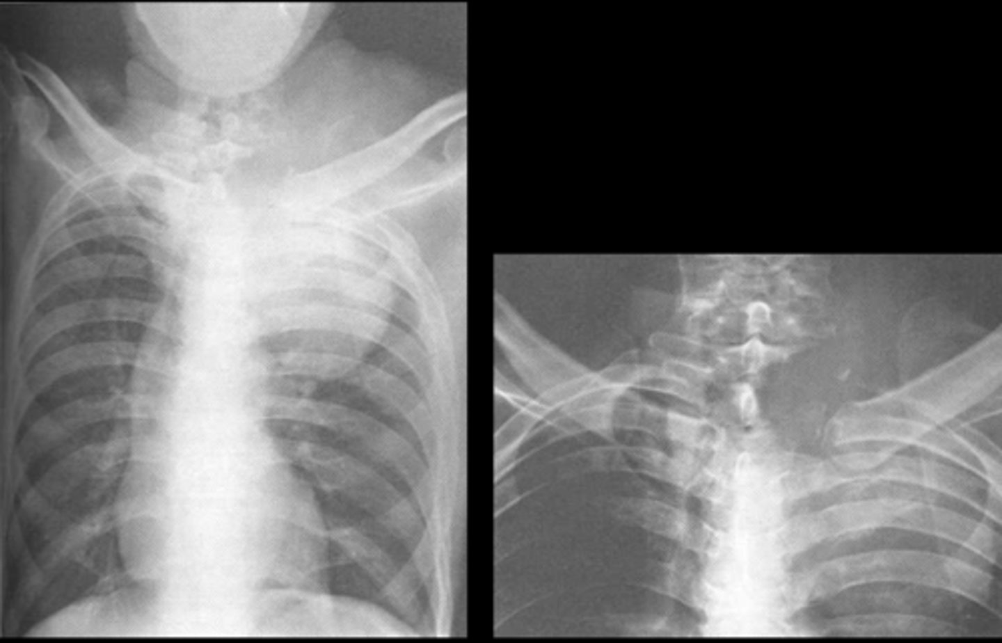 <p>- Lung cancer that occurs in the superior sulcus</p><p>- Bronchogenic carcinoma</p><p>- Rib and spine destruction</p><p>- Horner's syndrome</p>