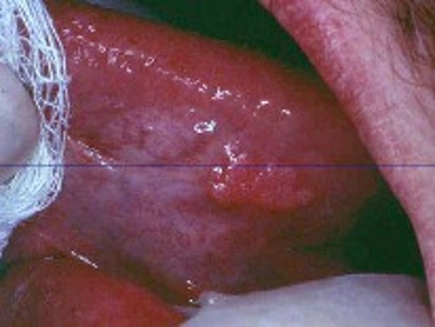 <p>Verruciform xanthoma</p>