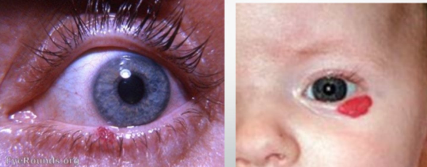 <p>self-resolving in 70% of pediatric cases</p><p>intralesional steroid</p><p>surgical excision w/ cautery</p><p>propranolol (oral)</p>