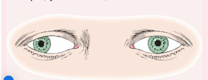 <p><span> (eye turns outward).</span></p>