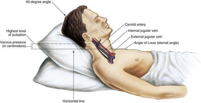 <ol><li><p>position patient supine at a 30-45 angle</p></li><li><p>observe for jugular vein pulsation</p></li><li><p>look for jugular vein distention (JVD) - may suggest heart failure</p></li></ol><p></p>