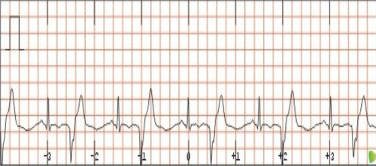 <p>What does the ECG show?</p>