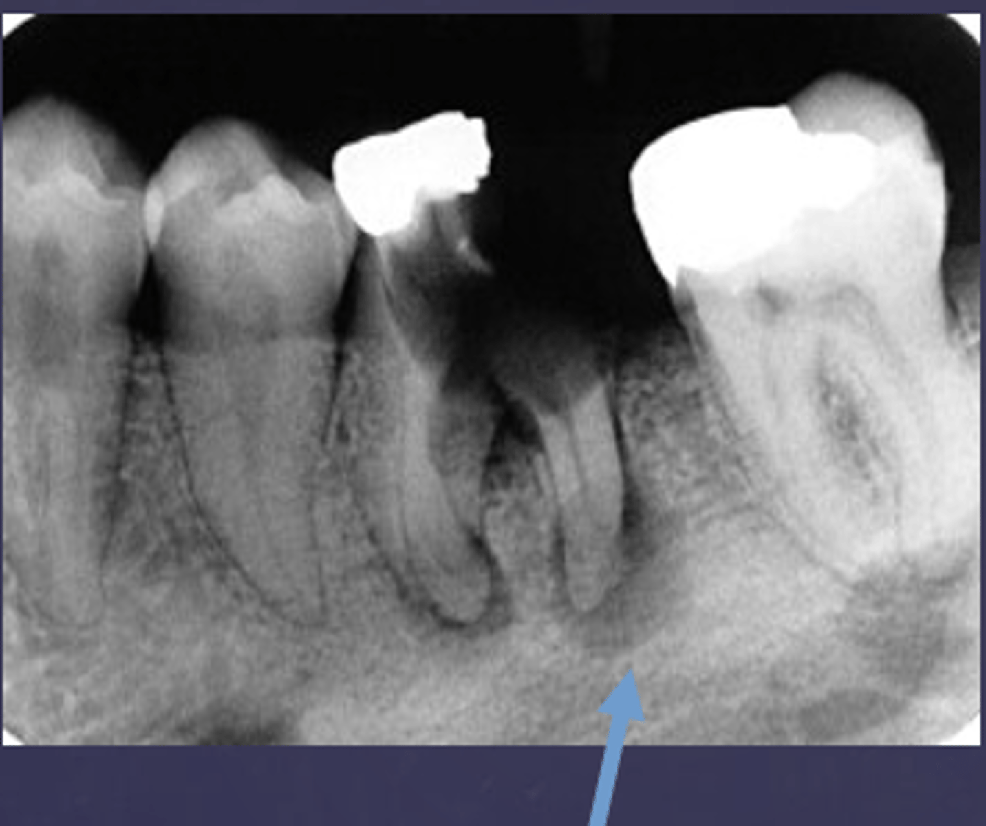 <p>This radiopaque area is classified as rarefying or sclerosing?</p>