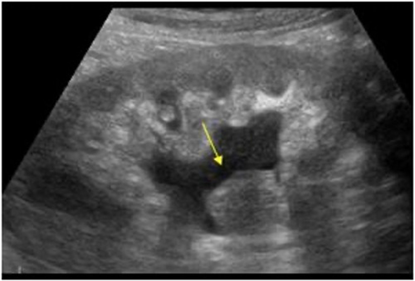 <p>What is the sonographic appearance of TCC? </p>