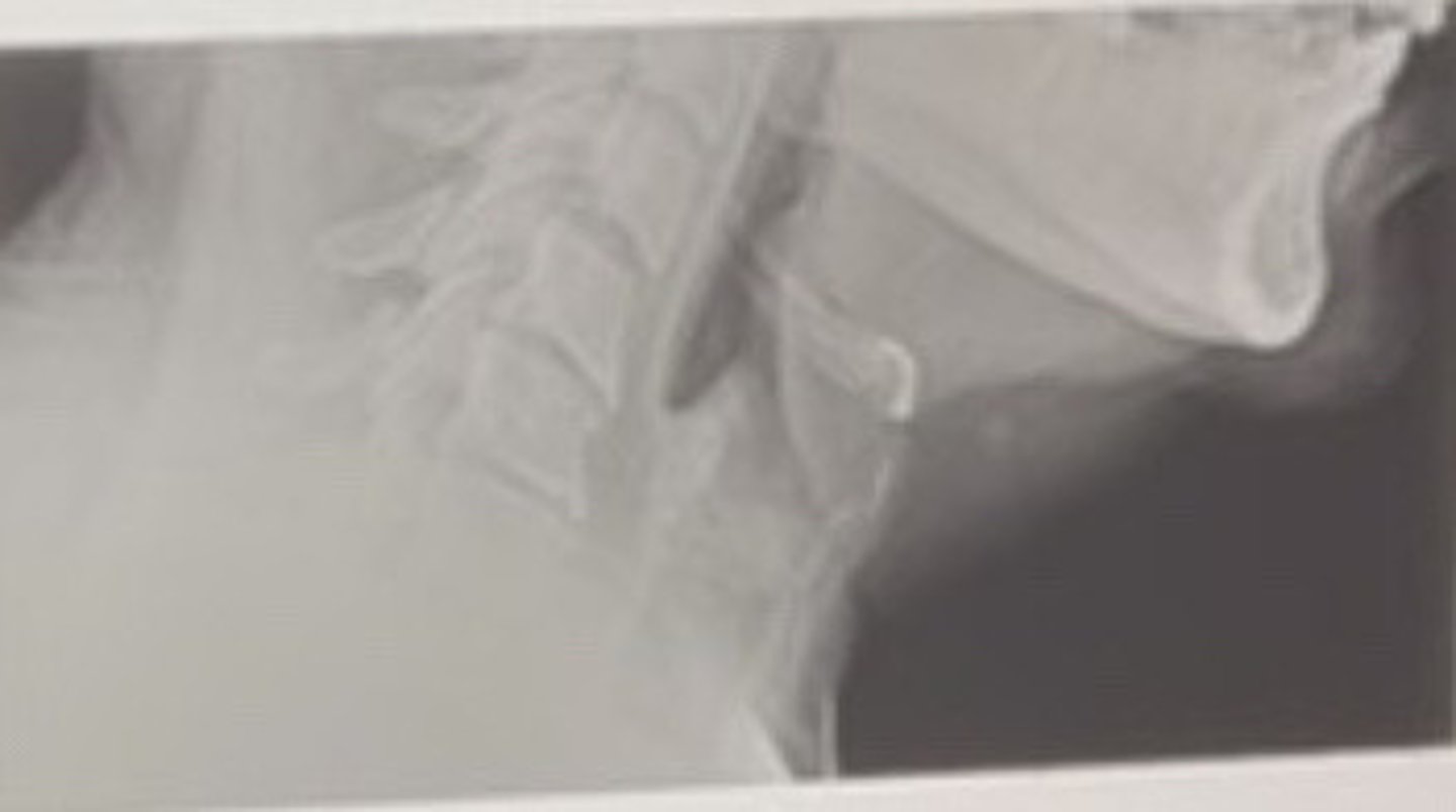 <p>The most likely symptom/finding for the patient above is?</p>