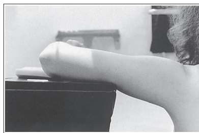 <ul><li><p>Distal capitulum is too far proximal to the distal medial trochlear surface of the radial head is too far anterior to the coronoid process</p></li><li><p>Distal forearm is depressed </p></li></ul><p></p>