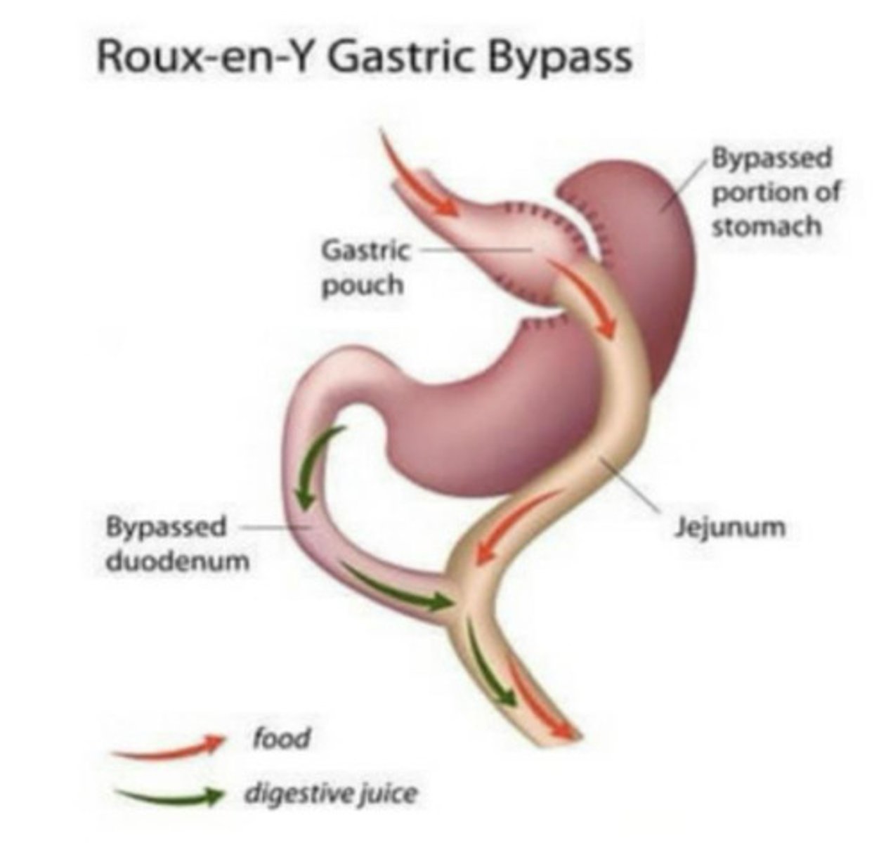 <p>Bariatric surgery that involves stapling the stomach to decrease its size <br>Shortening the jejunum and connecting it to the small stomach pouch, causing the base of the duodenum leading from the nonfunctioning portion of the stomach to form a Y configuration<br>Decreases the pathway of food through the intestine, thus reducing absorption of calories and fats</p>