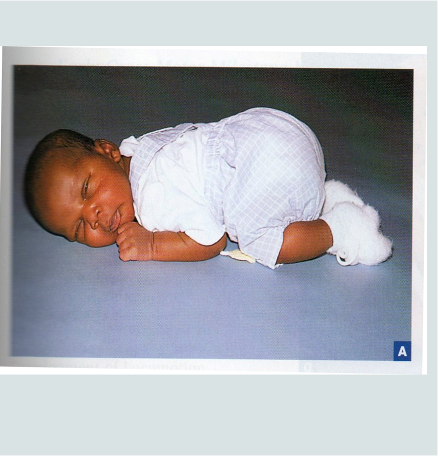 <ul><li><p>An infant lying prone is tightly flexed </p></li><li><p>Control of the upper trunk in the first few months develops along with a decrease in flexor tone (head to toe muscle control progression): should be able to control the weight of the upper trunk on their forearms by 4 months </p></li><li><p>Should not see floppiness or a 4 month old that cannot extend their arms (spasticity) </p></li></ul><p></p><p></p>