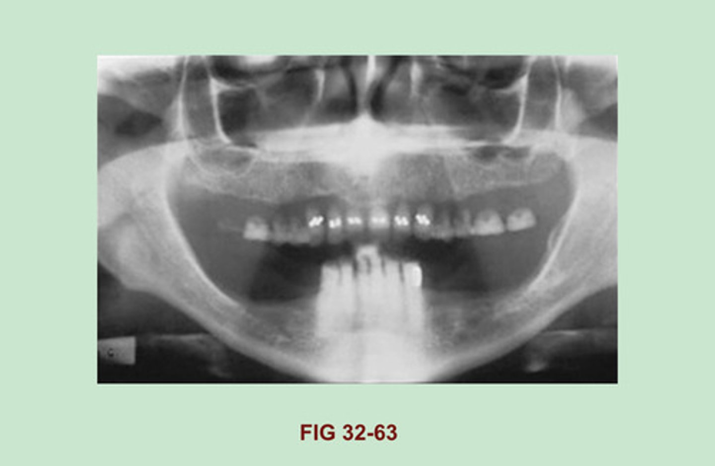 <p>Dentures were not removed prior to exposure.</p>