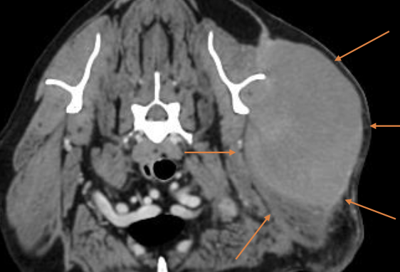 <p>slow growing mass that is usually non-painful</p><p>clinical signs depend on location of mass and invasiveness</p>