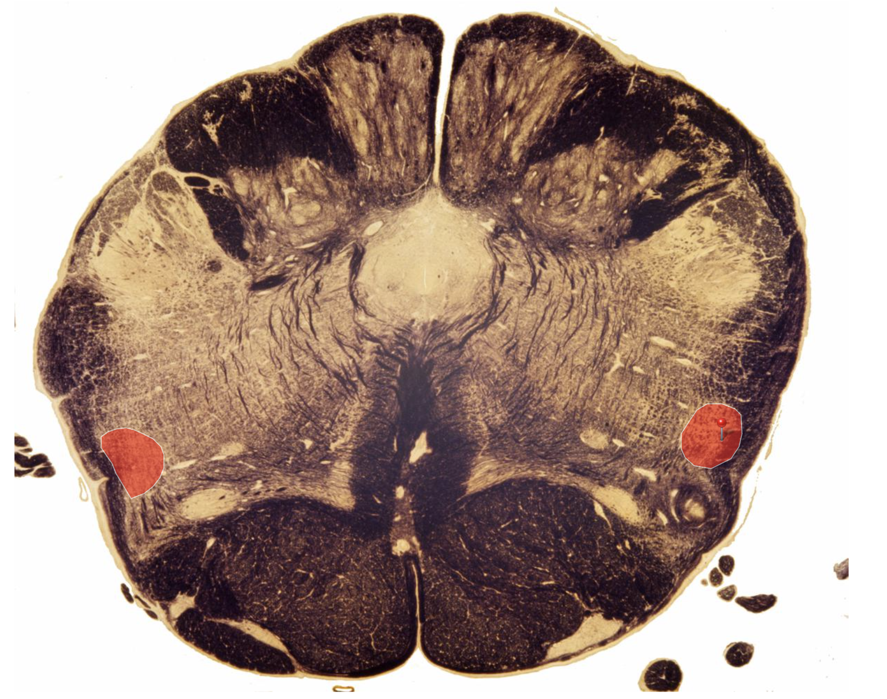 <p>Spinothalamic Tract, In more rostral Inferior Medulla (Sensory Decussation)</p>