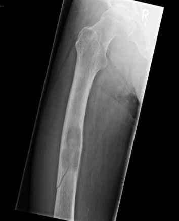 <p>What fracture is this?</p>