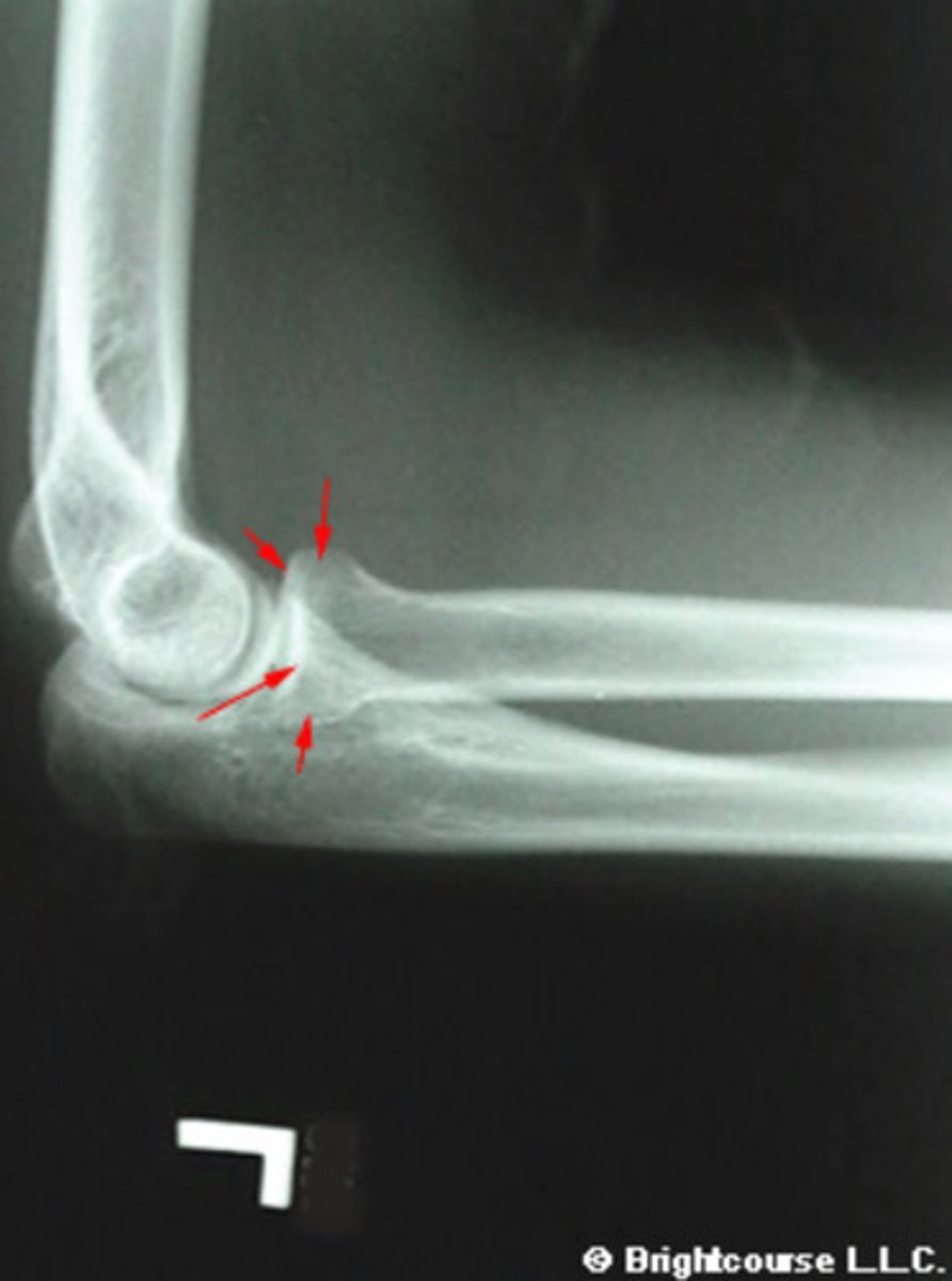 <p>What structure is being pointed out by the arrows?</p>