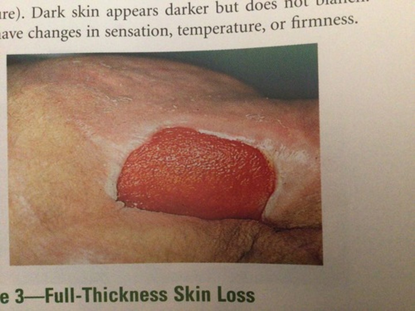 <p>Pressure Injuries: Stage</p>